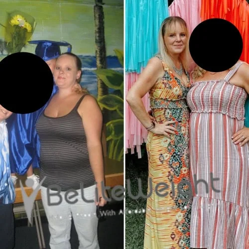 Weight Loss Surgery Before And After Dawn B - 2 Year Update*